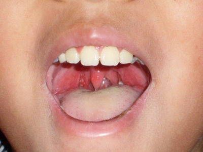 小儿疱疹性咽峡炎的症状和图片 