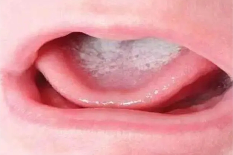 新生儿鹅口疮舌头症状图 新生儿鹅口疮舌头症状图