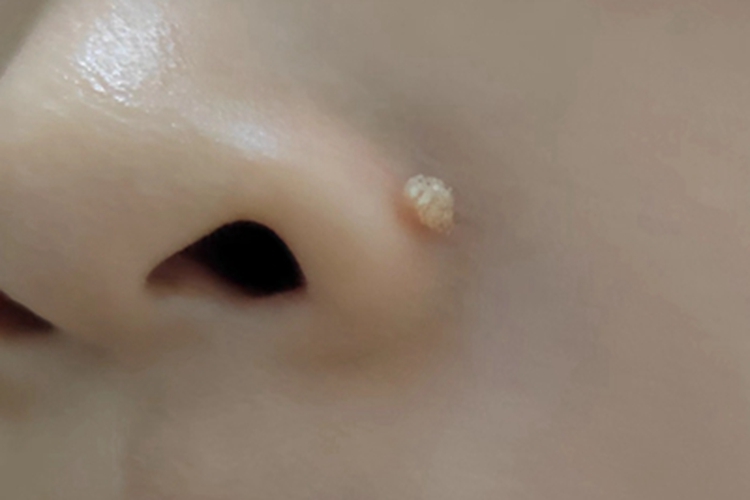 寻常疣鼻翼小疙瘩图 寻常疣鼻翼小疙瘩图