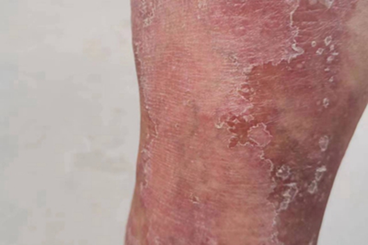 红皮病型银屑病腿脱皮图