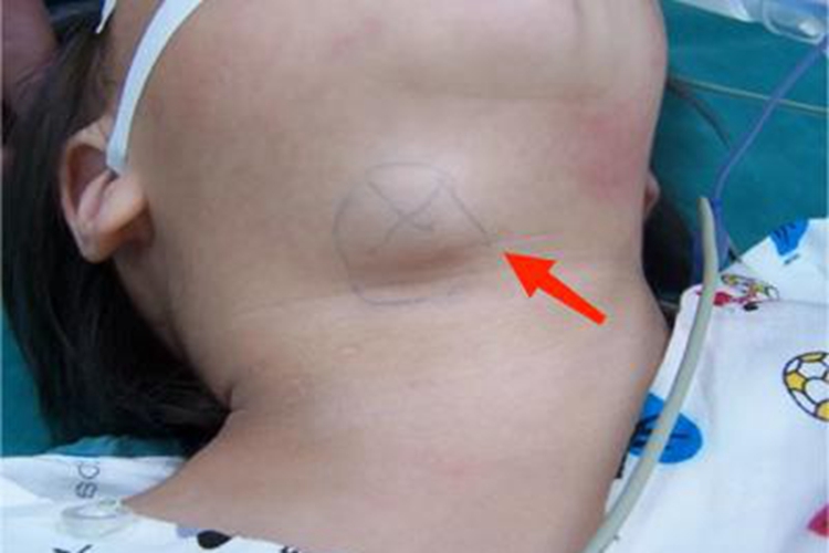 鳃裂囊肿颈部症状图 鳃裂囊肿颈部症状图