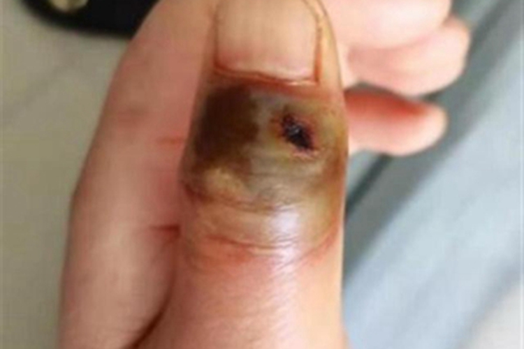 皮肤炭疽皮肤发黑图