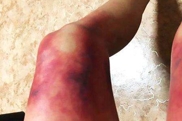 Ⅲ度冻伤腿发紫图