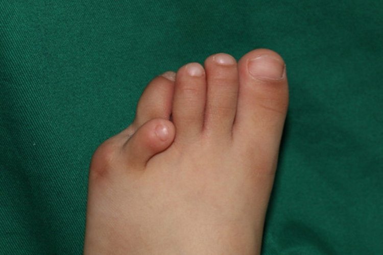 先天性仰趾畸形图