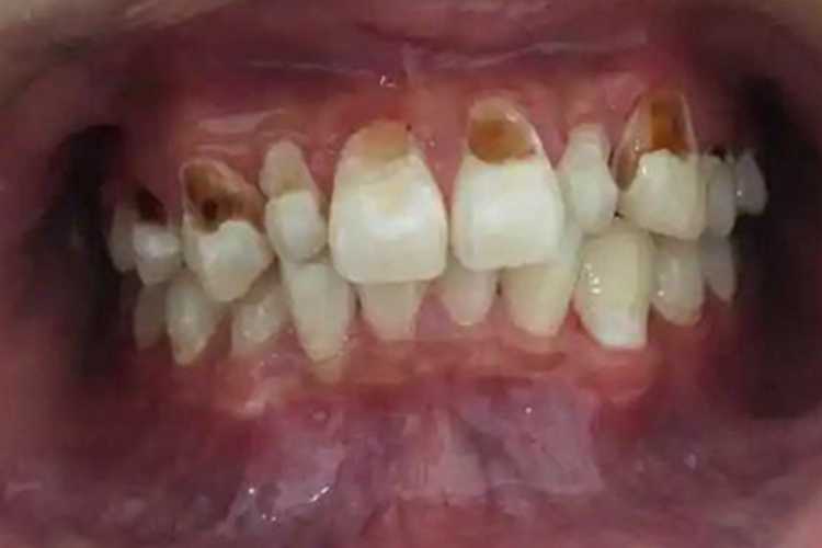 酸蚀症牙齿黄斑图