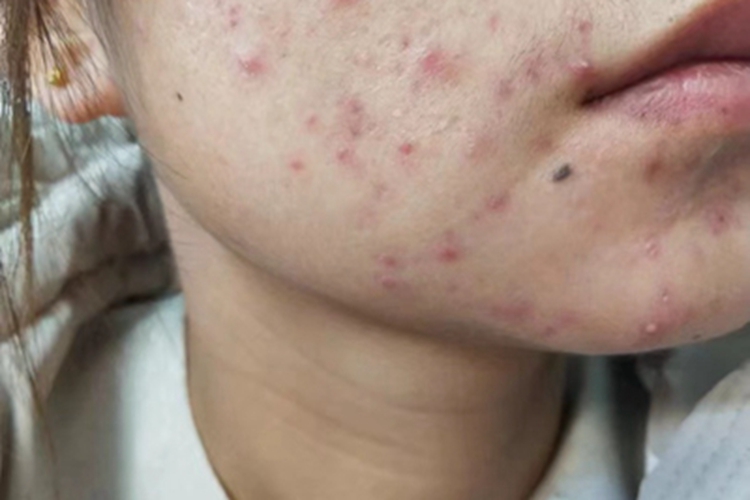 油痤疮面部丘疹图 油痤疮面部丘疹图