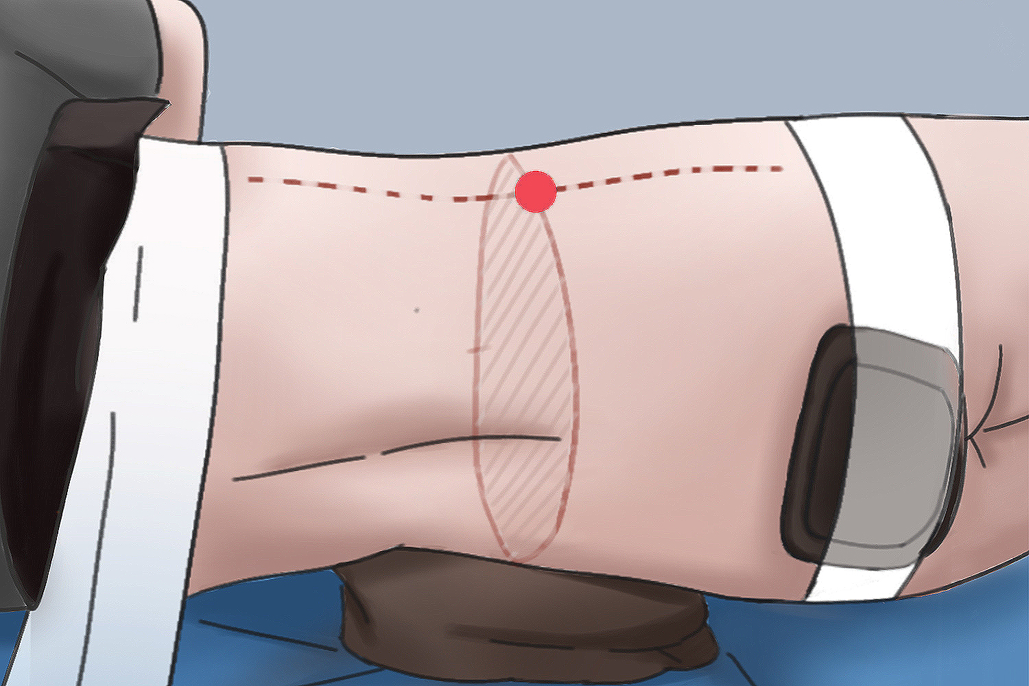 侧卧位穿刺点图 侧卧位穿刺点图