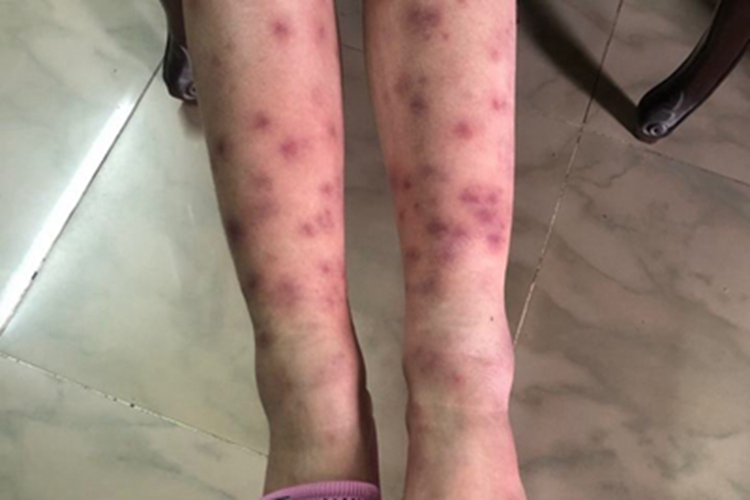 镰刀菌病小腿丘疹图 镰刀菌病小腿丘疹图