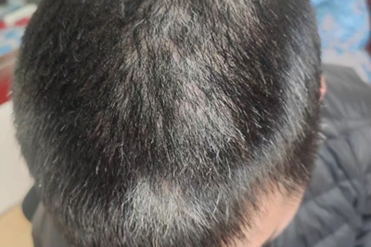 散发型白癜风头皮症状图