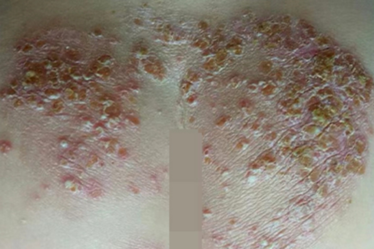 泛发性脓疱型银屑病臀部症状图 泛发性脓疱型银屑病臀部症状图