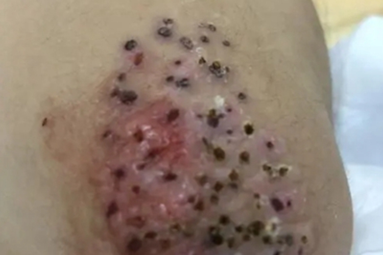 黑头粉刺痣肘部症状图 黑头粉刺痣肘部症状图