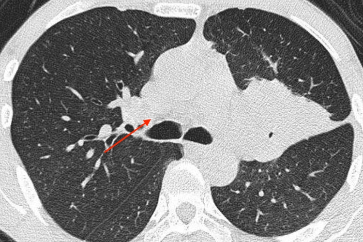 中央型肺癌CT图