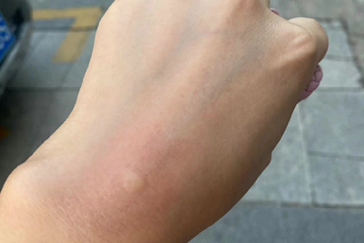 蚊子叮咬引起的皮肤反应红斑图