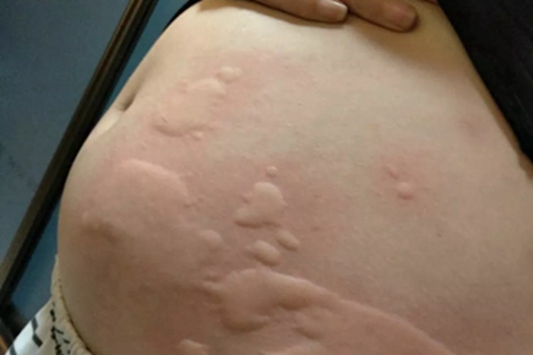 皮肤过敏红肿腹部症状图