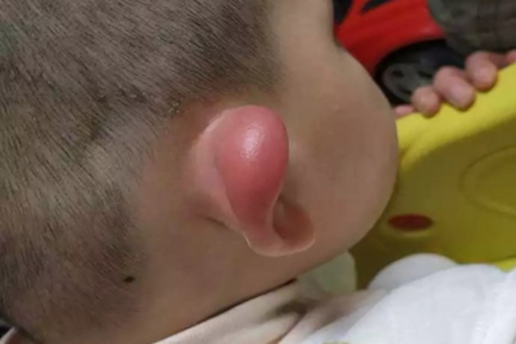 皮肤过敏红肿耳朵红肿图