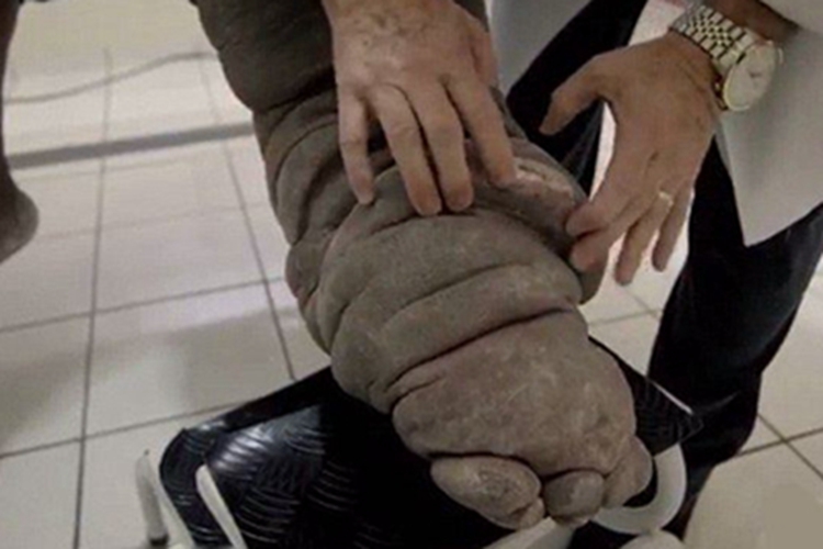 淋巴丝虫病皮肤粗糙图