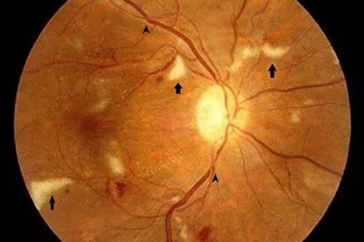 慢性高血压视网膜病变视网膜斑图 慢性高血压视网膜病变视网膜斑图