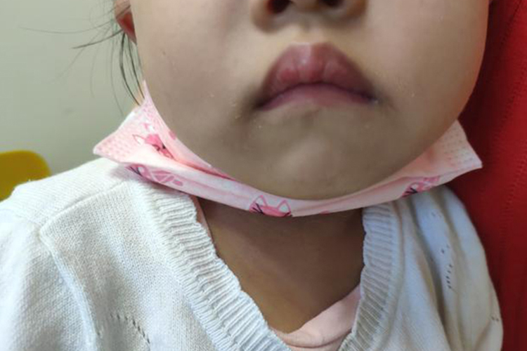 腺样体肥大上嘴唇突出图