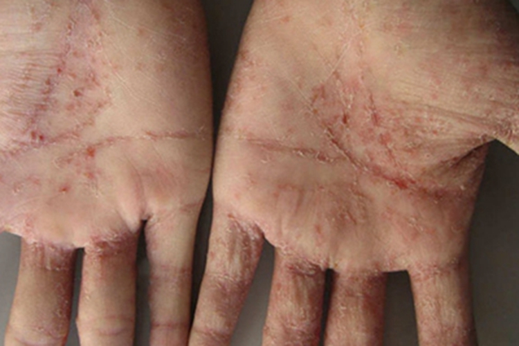 结痂性疥疮脱皮图 结痂性疥疮脱皮图