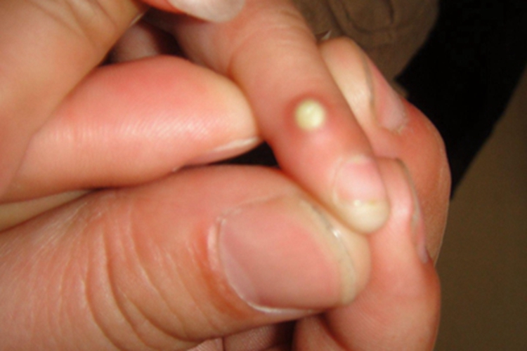 特发性皮肤钙质沉着症疙瘩图