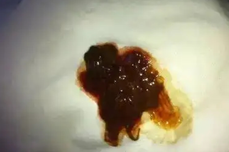 大肠湿热大便有脓血图