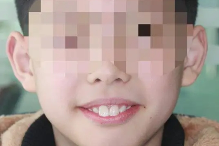 儿童门牙前突图