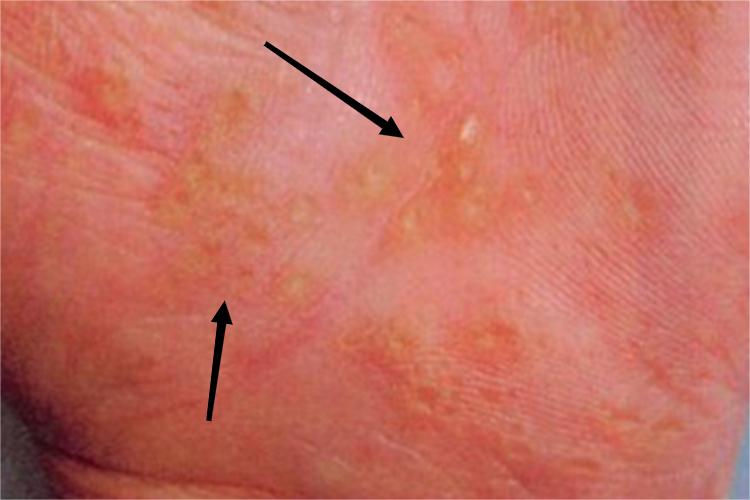 点状掌跖角化病丘疹图 点状掌跖角化病丘疹图