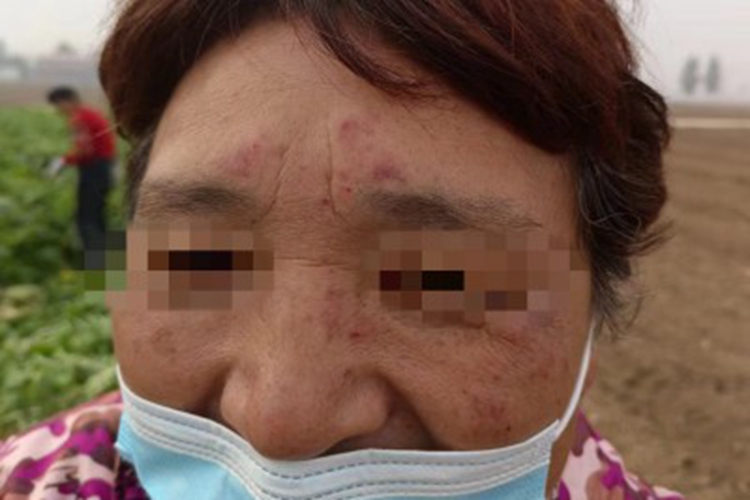 日光性皮炎面部血痂图