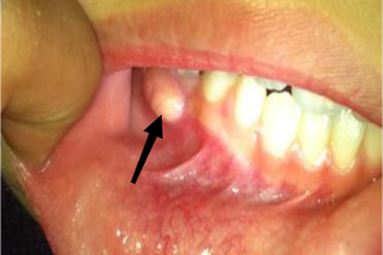 急性根尖周炎牙龈脓疱图