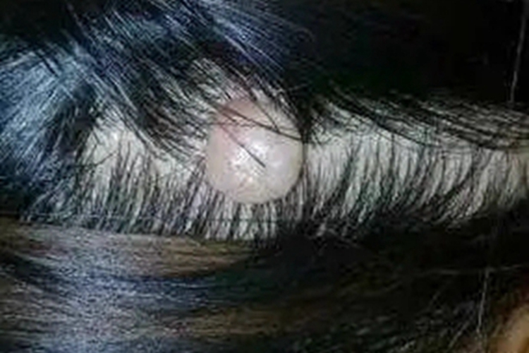 毛母质瘤头部症状图