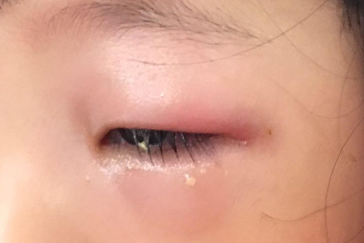 睑腺炎眼睑水肿图