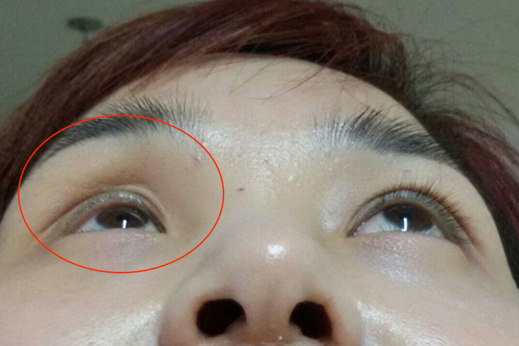 眼眶爆裂性骨折眼球内陷图 眼眶爆裂性骨折眼球内陷图