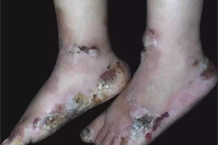 单纯型大疱性表皮松解症脚结痂图