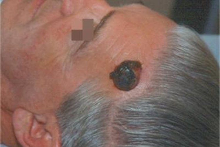 恶性雀斑痣样黑素瘤前额糜烂图