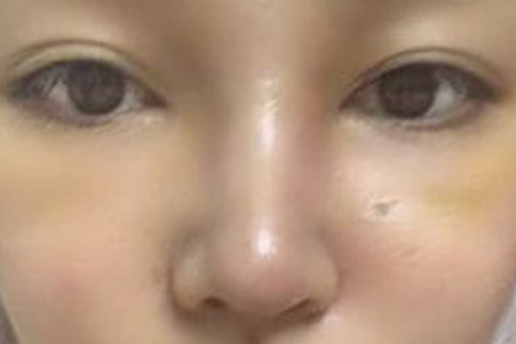 隆鼻恢复期山根轻微肿胀图