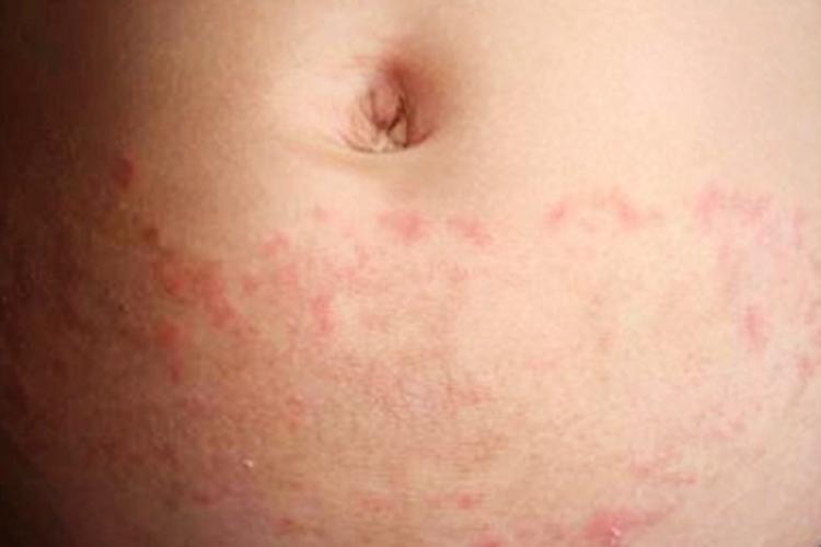 脓毒败血症疹腹部症状图