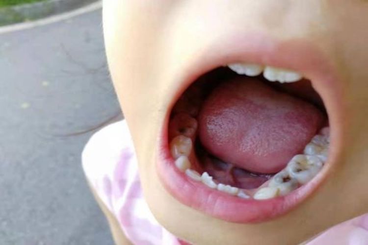 乳牙后牙浅龋图 乳牙后牙浅龋图