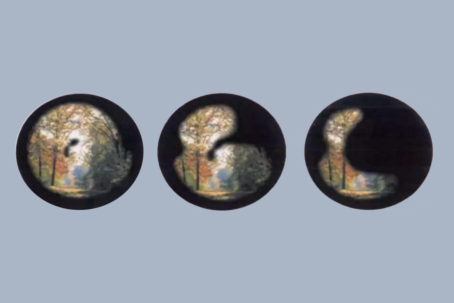 白内障视觉效果图