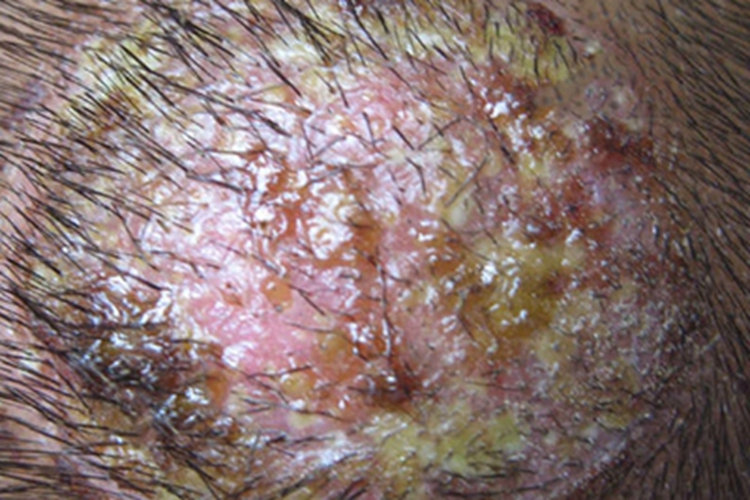 脓癣头上流黄色脓图