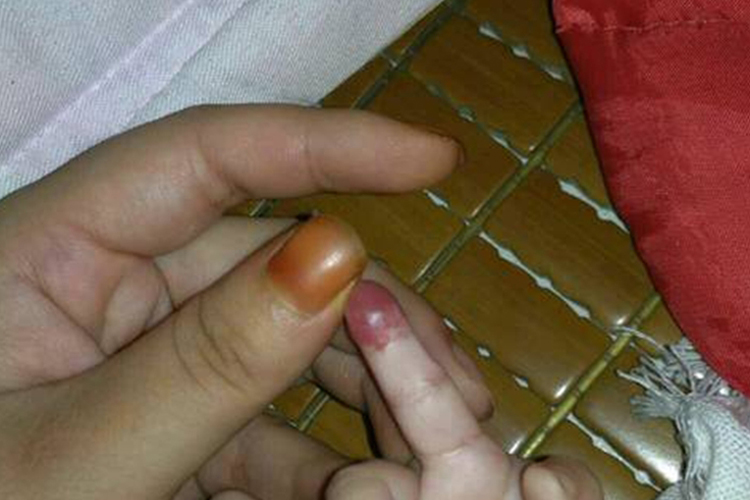 手上起了一个蔓状血管瘤图