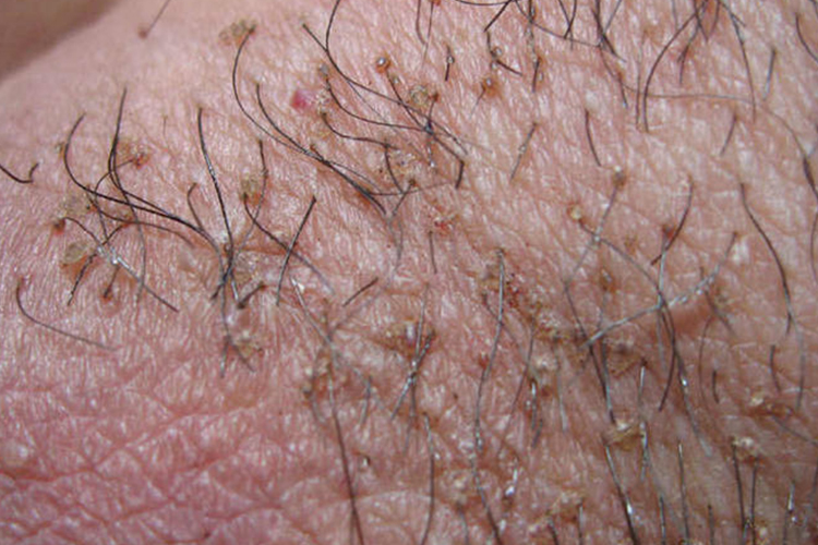 阴虱丘疹图 阴虱丘疹图