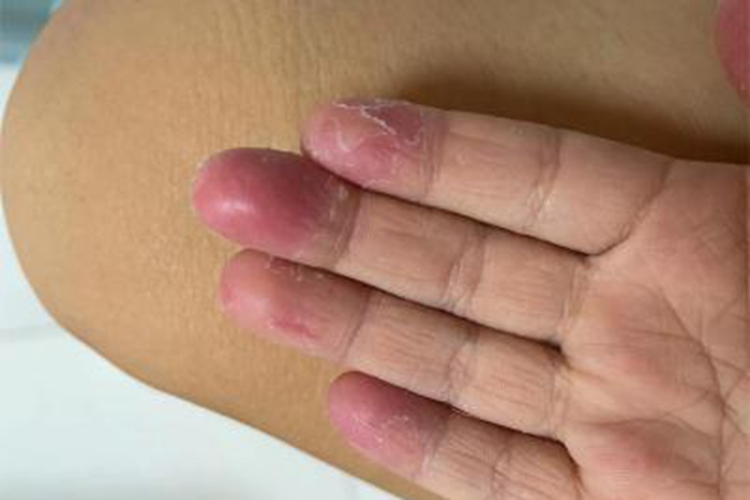 亚急性湿疹手部症状图