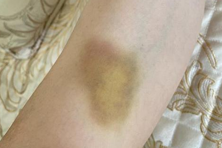 皮下出血棕黄色图 皮下出血棕黄色图
