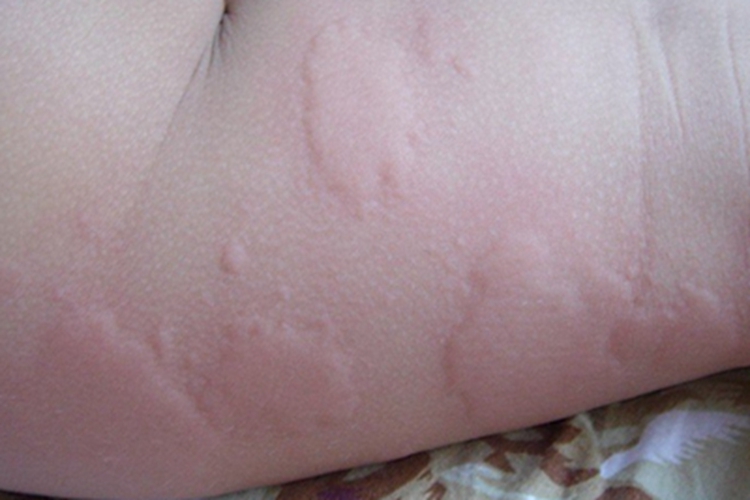 荨麻疹性血管炎风团图