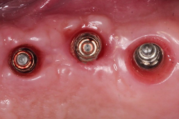 种植牙一期伤口愈合良好图 种植牙一期伤口愈合良好图