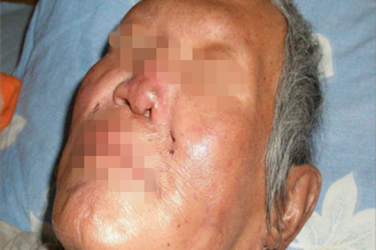 瘤型麻风眉毛脱没图