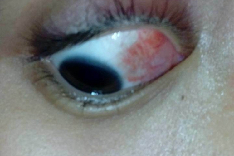 结膜炎眼球症状图 结膜炎眼球症状图