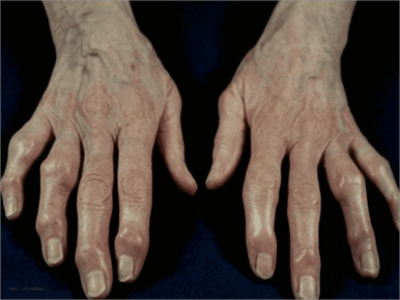 费尔蒂综合征手部关节突出畸形图