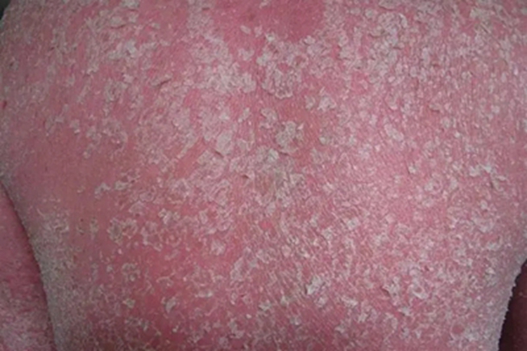 红皮病脱屑期背部脱屑图