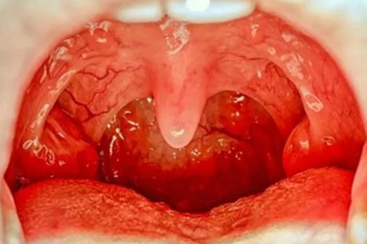 淋菌性咽炎咽后壁红肿图